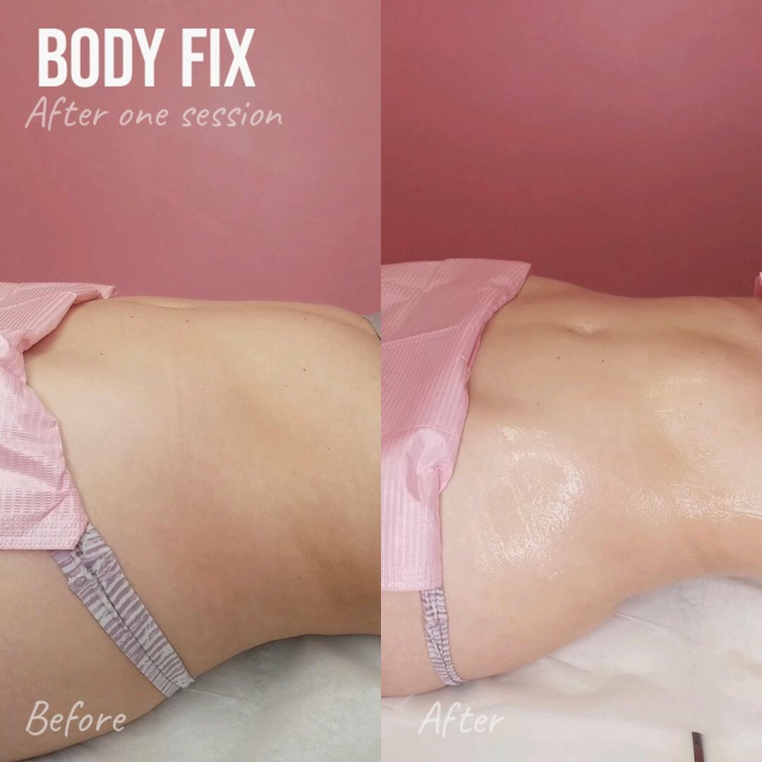 Body Contouring in Los Angeles